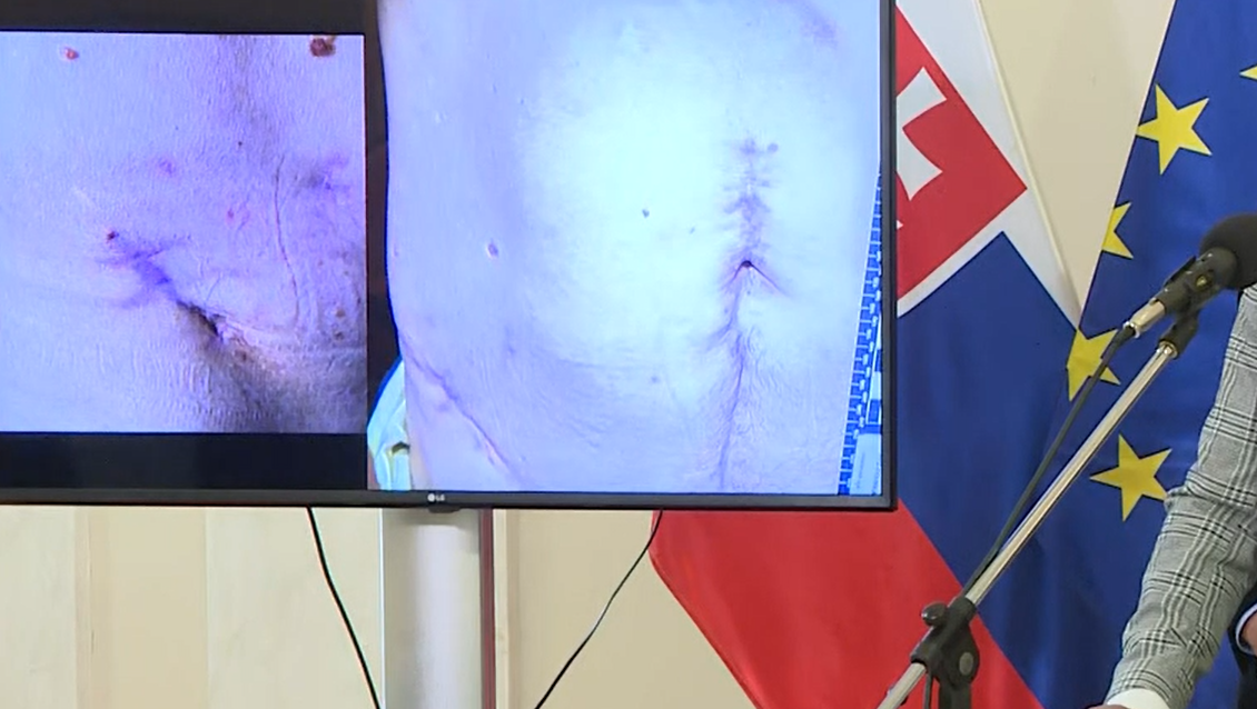 Zranenia premiéra po operácii